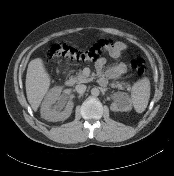 File:Atrophic kidney due to severe chronic obstructive hydronephrosis (Radiopaedia 40828-43474 Axial non-contrast 4).jpg