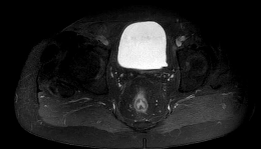 Atypical lipomatous tumor - thigh (Radiopaedia 68975-78734 Axial T1 C+ fat sat 96).jpg
