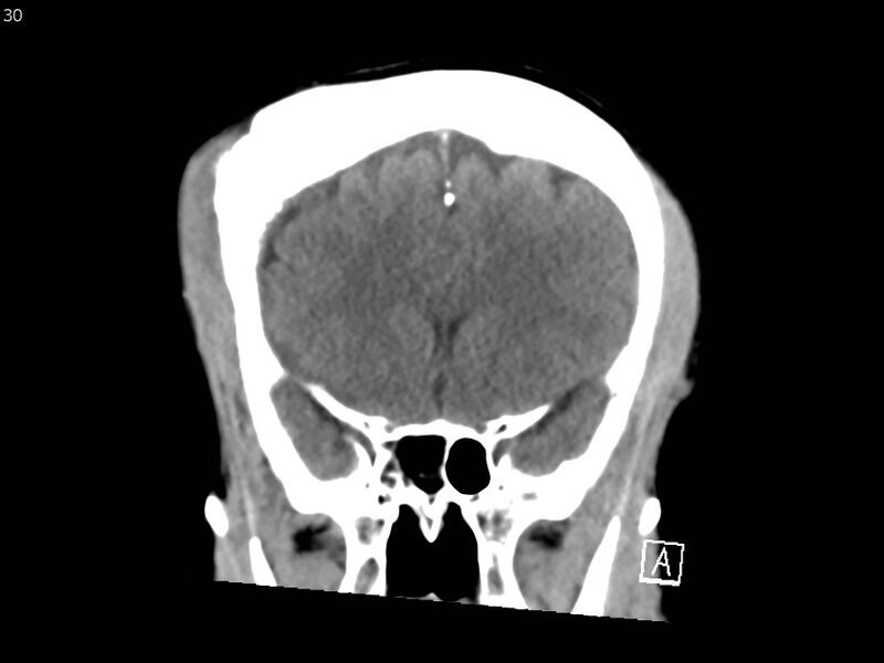 File:Atypical meningioma - intraosseous (Radiopaedia 64915-73867 B 29).jpg