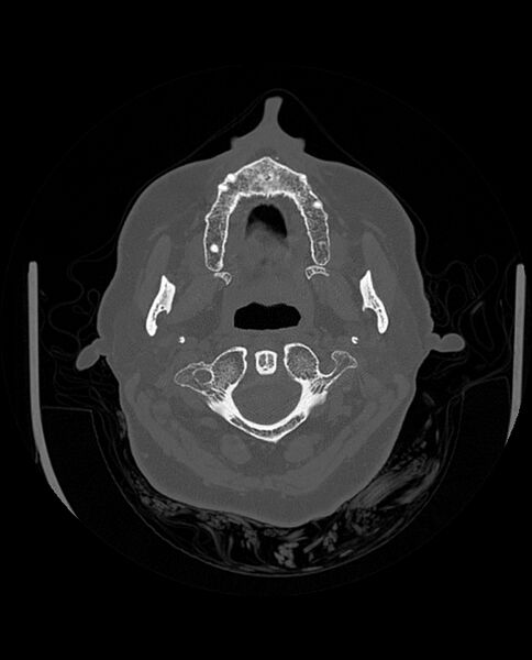 File:Automastoidectomy with labyrinthine fistula (Radiopaedia 84143-99411 Axial non-contrast 35).jpg