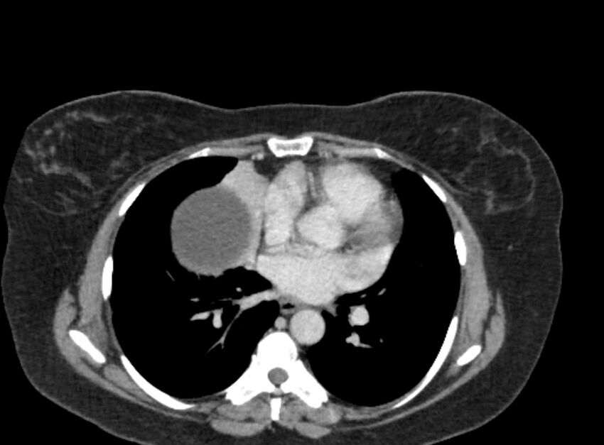 Autosomal dominant polycystic kidney disease (Radiopaedia 57124-64017 A 4).jpg