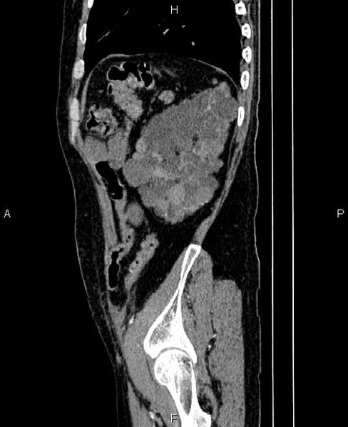 File:Autosomal dominant polycystic kidney disease (Radiopaedia 87830-104287 C 76).jpg