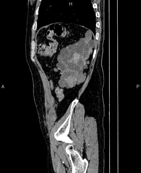File:Autosomal dominant polycystic kidney disease (Radiopaedia 87830-104287 C 80).jpg