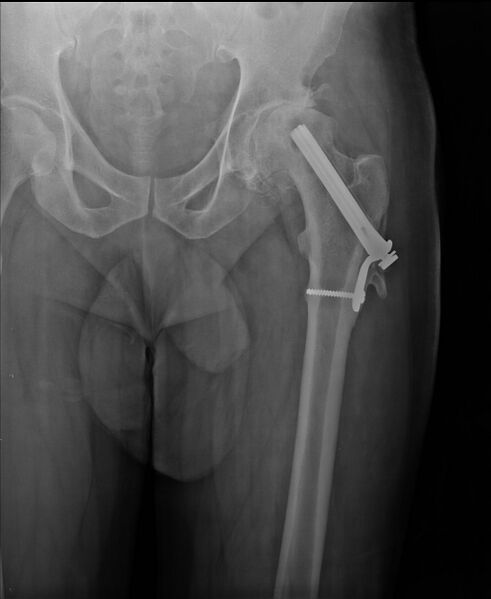 File:Avascular necrosis of the hip (Radiopaedia 12738).jpg