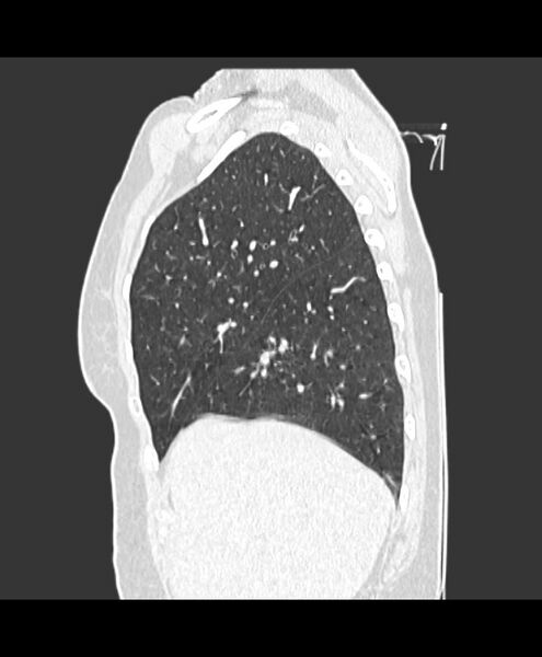 File:Azygos fissure and azygos lobe (Radiopaedia 41841-44832 Sagittal lung window 1).jpg