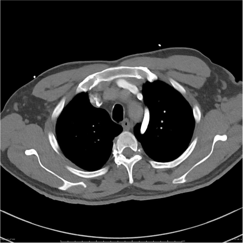 Azygos venous system anatomy (CT pulmonary angiography) (Radiopaedia 25928-26077 Axial C+ CTPA 17).jpg