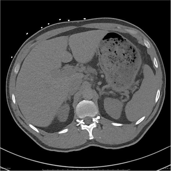 File:Azygos venous system anatomy (CT pulmonary angiography) (Radiopaedia 25928-26077 Axial C+ CTPA 91).jpg