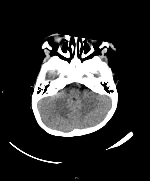 File:Basal ganglia and parenchymal ischemia (Radiopaedia 45818-50083 Axial non-contrast 35).jpg