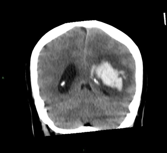 File:Basal ganglia hemorrhage (Radiopaedia 58759-65981 Coronal non-contrast 27).jpg