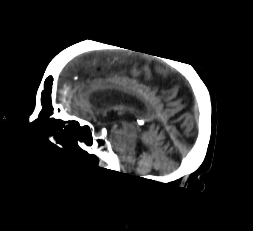 Basal ganglia hemorrhage (Radiopaedia 58762-65984 B 28).jpg