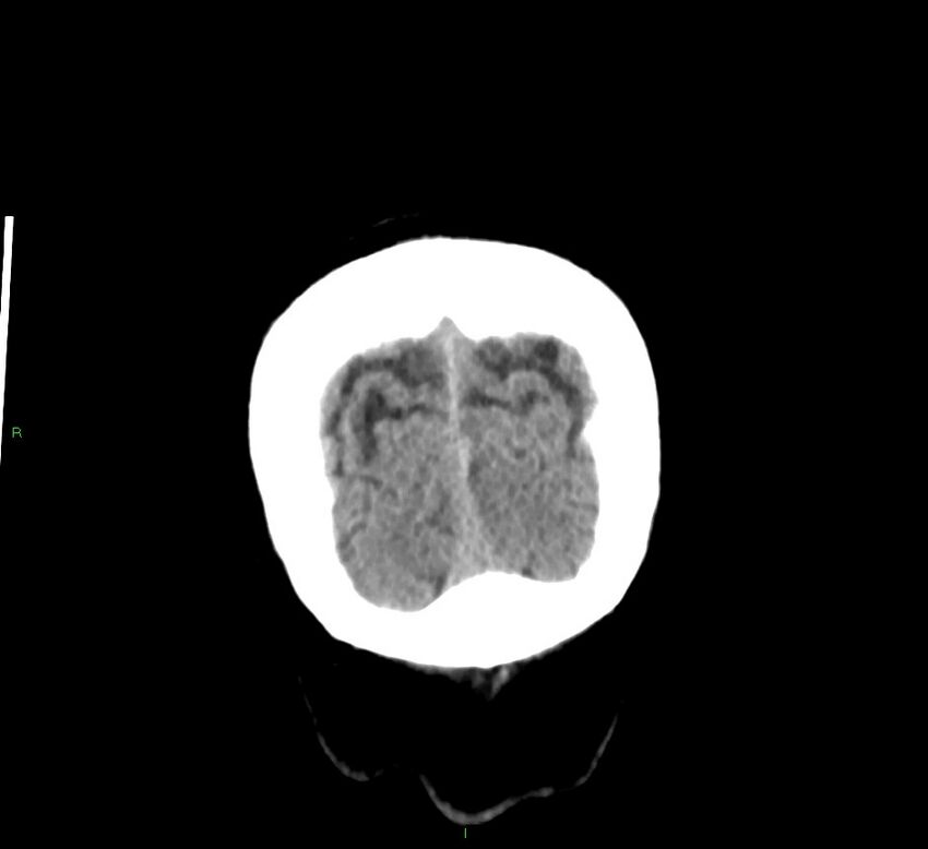 Basal ganglia hemorrhage (Radiopaedia 58791-66025 Coronal non-contrast 7).jpg