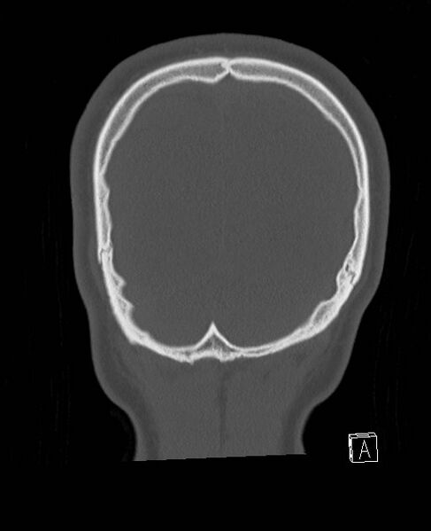 File:Base of skull fracture with bilateral Le Fort fractures (Radiopaedia 47094-51638 Coronal bone window 14).jpg