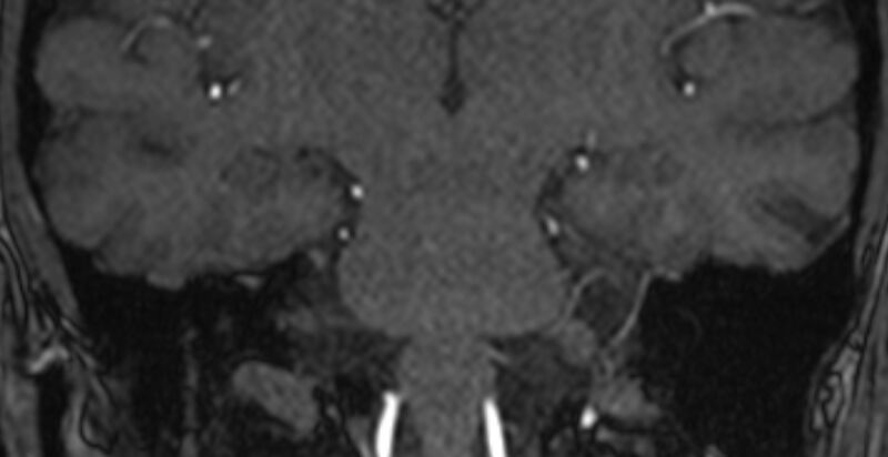 File:Basilar artery fenestration (Radiopaedia 74537-85455 Coronal MRA TOF 77).jpg