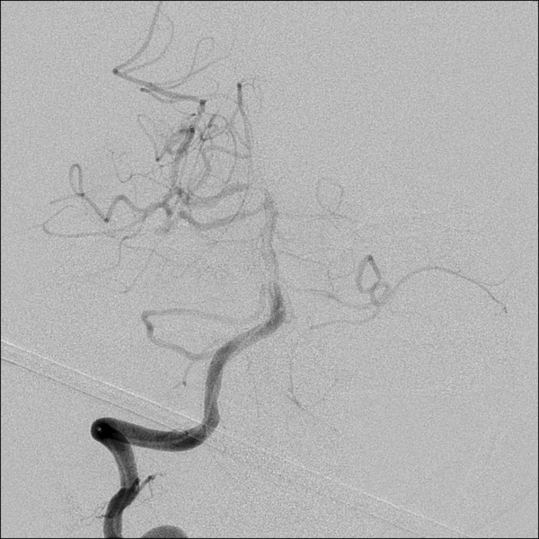 File:Basilar artery thrombosis treated with intra-arterial urokinase (Radiopaedia 34571-35949 B 14).png