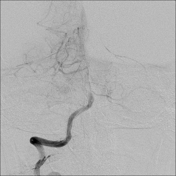 File:Basilar artery thrombosis treated with intra-arterial urokinase (Radiopaedia 34571-35949 B 19).png