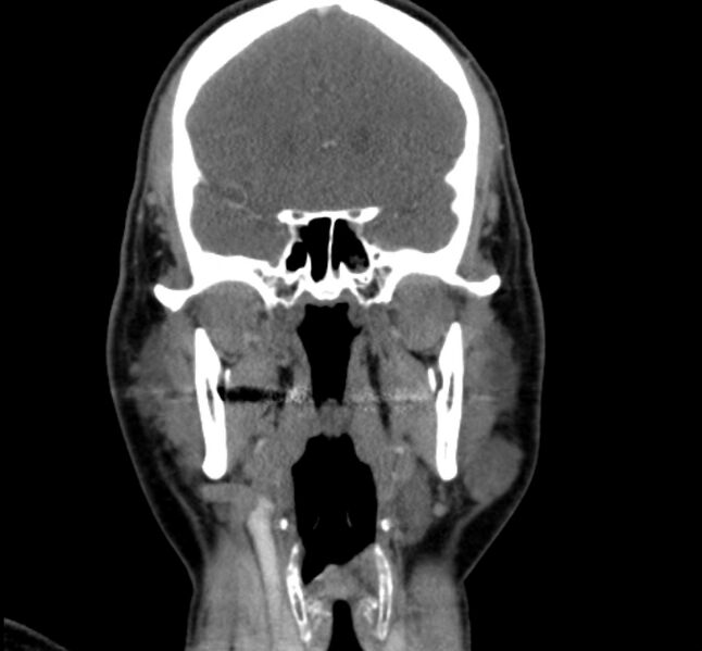 File:Benign mixed salivary tumor of the parotid gland (Radiopaedia 35261-36792 B 13).jpg