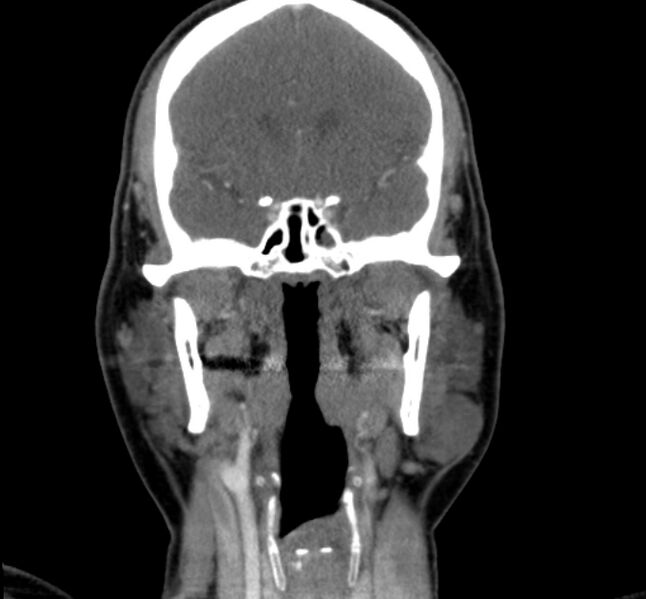 File:Benign mixed salivary tumor of the parotid gland (Radiopaedia 35261-36792 B 14).jpg