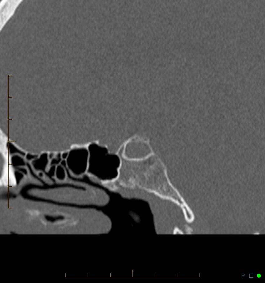 Benign notochordal cell tumor (probable) (Radiopaedia 65475-74546 Sagittal bone window 13).jpg