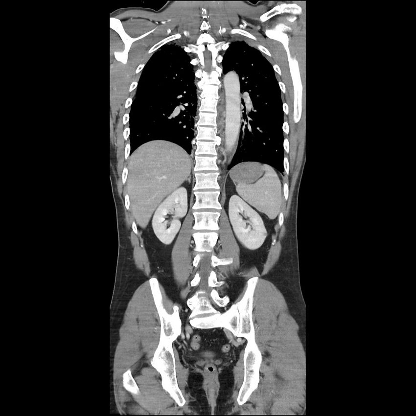 Benign post-traumatic pseudopneumoperitoneum (Radiopaedia 71199-81495 Coronal dual bolus 33).jpg