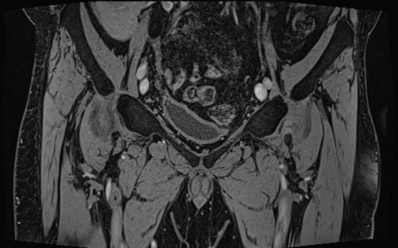 File:Bilateral avascular necrosis of femoral head (Radiopaedia 77116-89078 Coronal T2 we 76).jpg