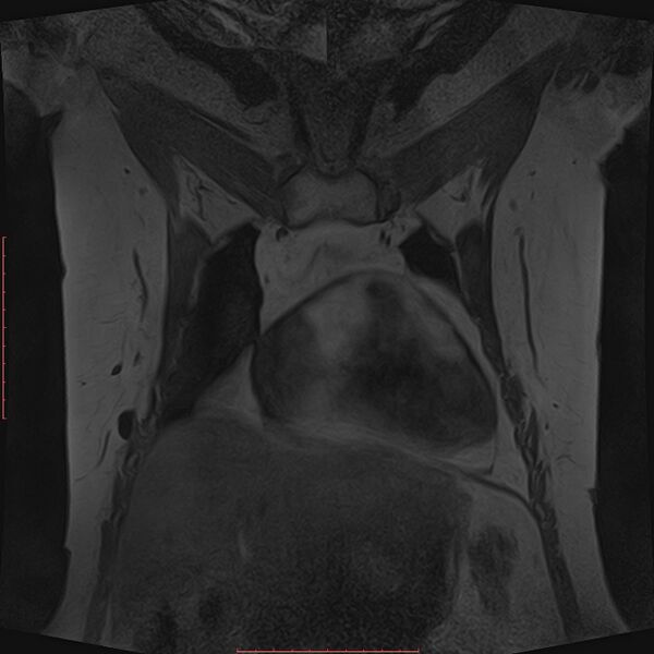 File:Bilateral breast implant rupture (Radiopaedia 24761-25027 G 17).jpg