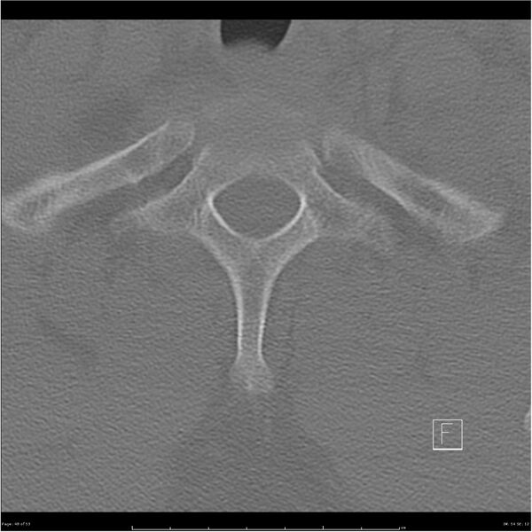 File:Bilateral cervical ribs (Radiopaedia 25868-26017 Axial bone window 48).jpg