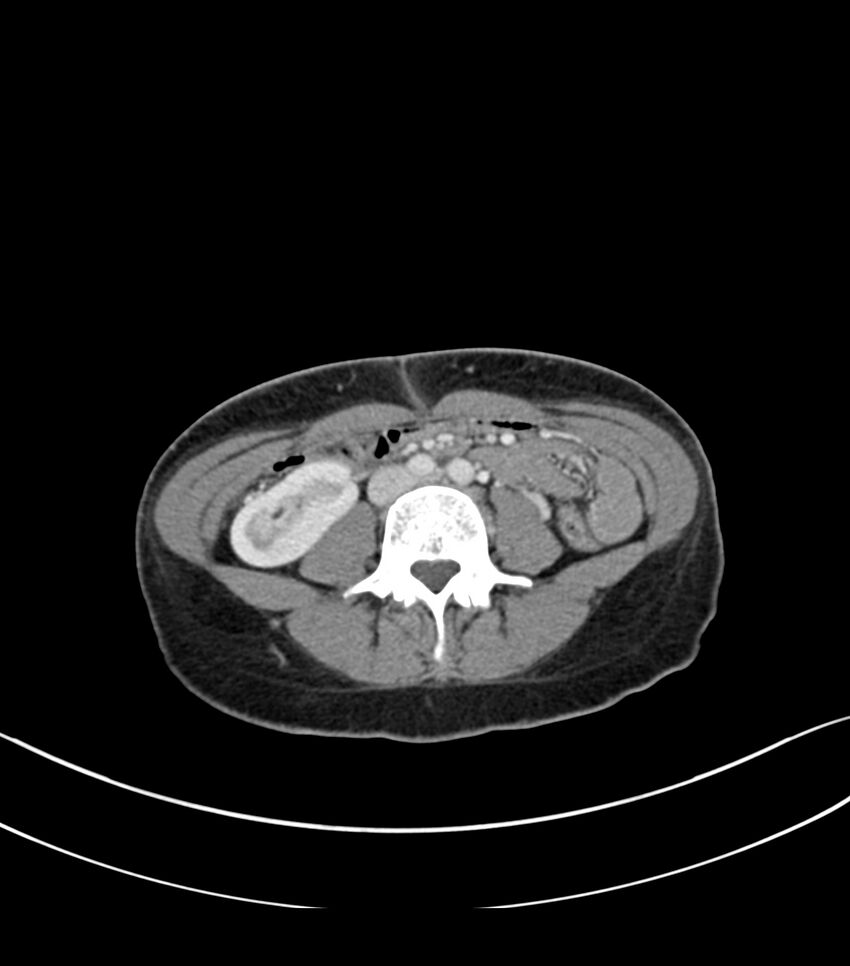 Bilateral kidney malrotation (Radiopaedia 72227-82749 A 39).jpg