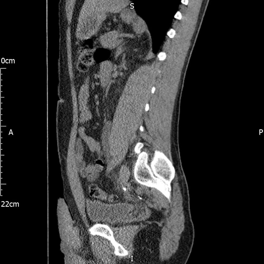 Bilateral medullary nephrocalcinosis with ureteric calculi (Radiopaedia 71269-81569 C 49).jpg