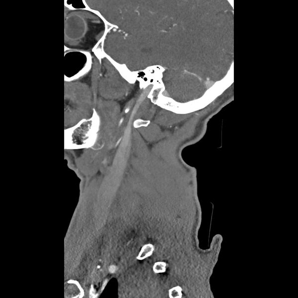 File:Bilateral perched facets with cord injury (Radiopaedia 45587-49713 B 5).jpg
