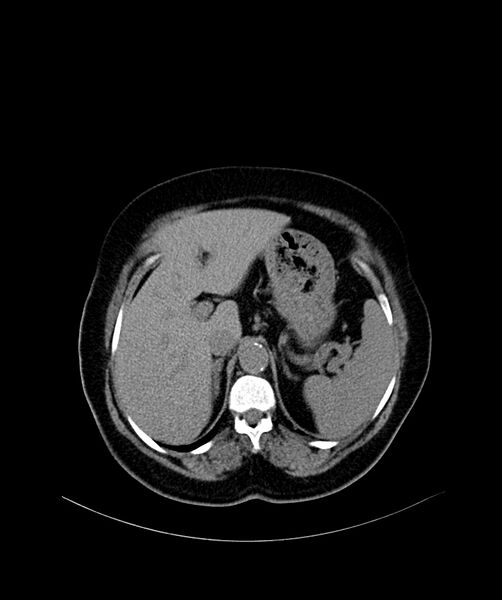 File:Bilateral sporadic synchronous clear cell renal cell carcinoma (Radiopaedia 85035-100572 Axial non-contrast 14).jpg
