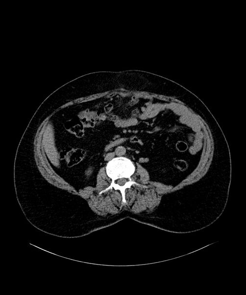 File:Bilateral sporadic synchronous clear cell renal cell carcinoma (Radiopaedia 85035-100572 Axial non-contrast 37).jpg