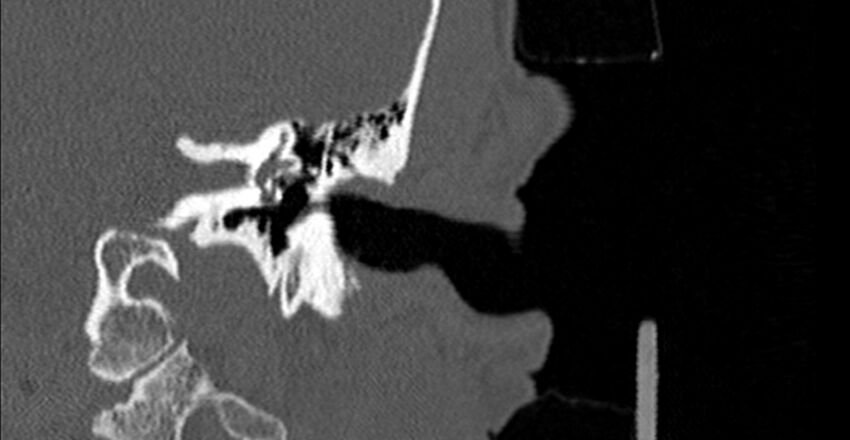 Bilateral temporal bone fractures (Radiopaedia 29482-29970 B 37).jpg