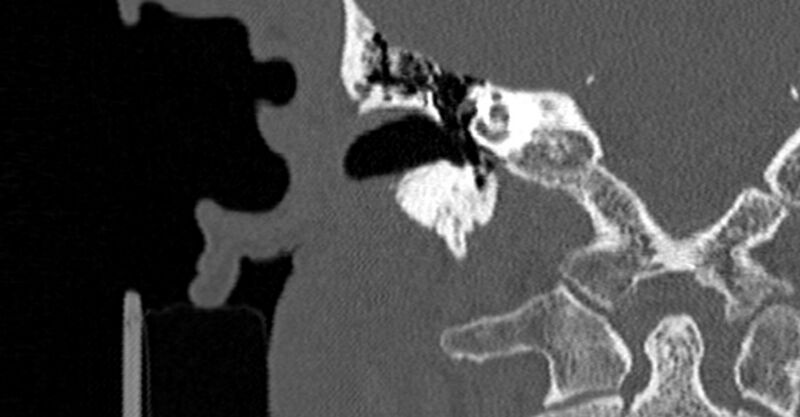 File:Bilateral temporal bone fractures (Radiopaedia 29482-29970 Coronal non-contrast 103).jpg