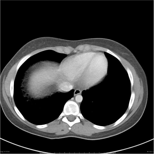 File:Bilateral ureteritis and cystitis (Radiopaedia 25340-25594 A 4).jpg