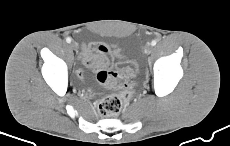 File:Blunt injury to the small bowel (Radiopaedia 74953-85987 A 168).jpg