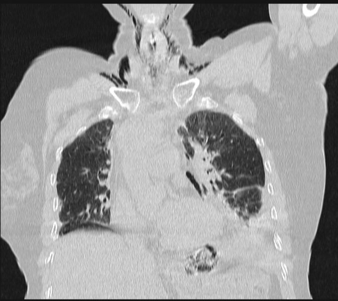 File:Boerhaave syndrome (Radiopaedia 45644-49799 Coronal lung window 27).jpg