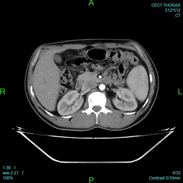 File:Bone metastases from lung carcinoma (Radiopaedia 54703-60937 Axial C+ delayed 4).jpg
