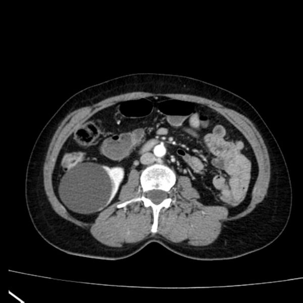 File:Bosniak renal cyst - type I (Radiopaedia 27479-27675 renal cortical phase 44).jpg