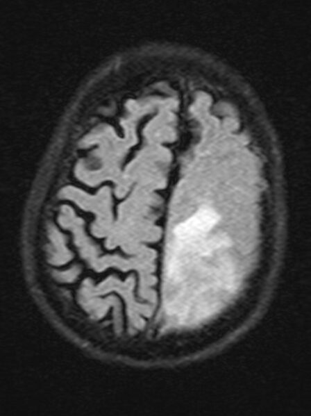 File:Brain abscess with dual rim sign (Radiopaedia 87566-103938 Axial FLAIR 19).jpg