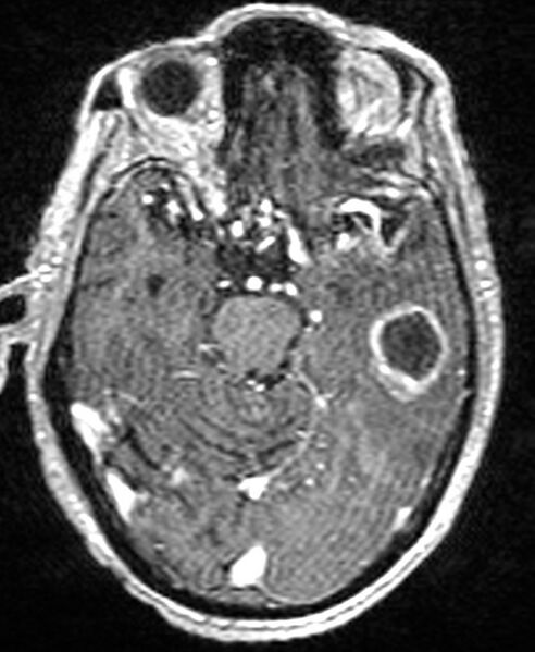 File:Brain abscess with dual rim sign (Radiopaedia 87566-103938 Axial T1 C+ 63).jpg