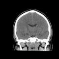 Brain death (Radiopaedia 78597-91360 Coronal non-contrast 39).jpg
