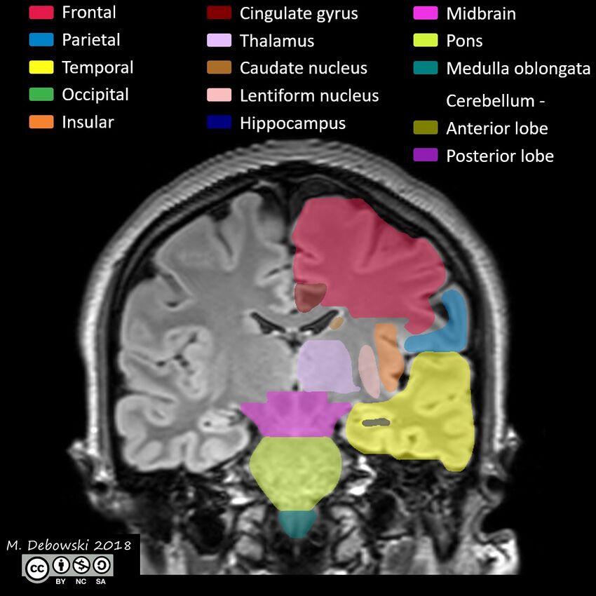 Brain lobes - annotated MRI (Radiopaedia 61691-69700 Coronal 38).JPG