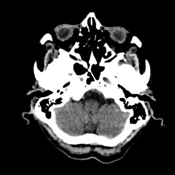 File:Brain metastases from lung cancer (Radiopaedia 27849-28092 Axial non-contrast 9).jpg