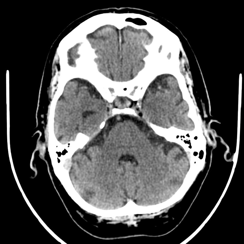 Brain metastasis (Radiopaedia 42617-45760 Axial non-contrast 11).jpg