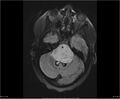 Brainstem glioma (Radiopaedia 21819-21775 Axial FLAIR 11).jpg