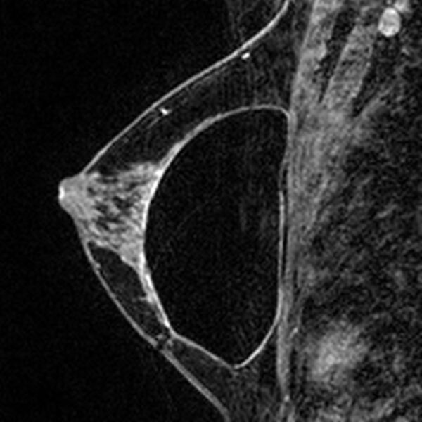 File:Breast implants - MRI (Radiopaedia 26864-27035 Sagittal T2 25).jpg