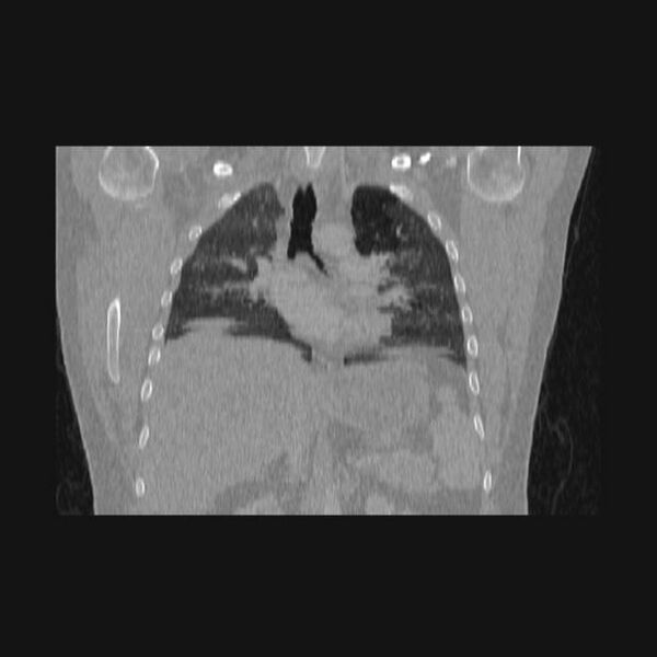 File:Bronchial atresia (Radiopaedia 60685-68439 Coronal lung window 36).jpg