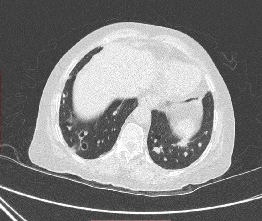 Bronchiectasis (Radiopaedia 72693-83293 Axial lung window 114).jpg