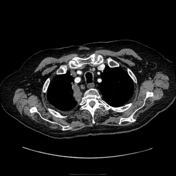 File:Bronchogenic adenocarcinoma and pulmonary embolism (Radiopaedia 9097-9806 D 13).jpg