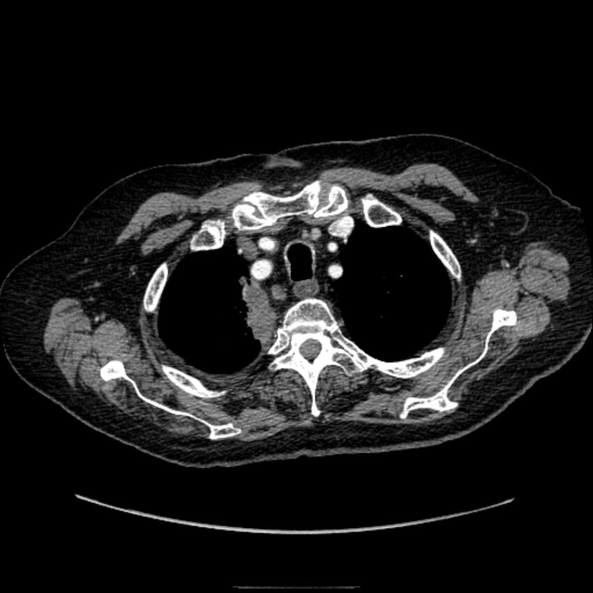 Bronchogenic adenocarcinoma and pulmonary embolism (Radiopaedia 9097-9806 D 13).jpg
